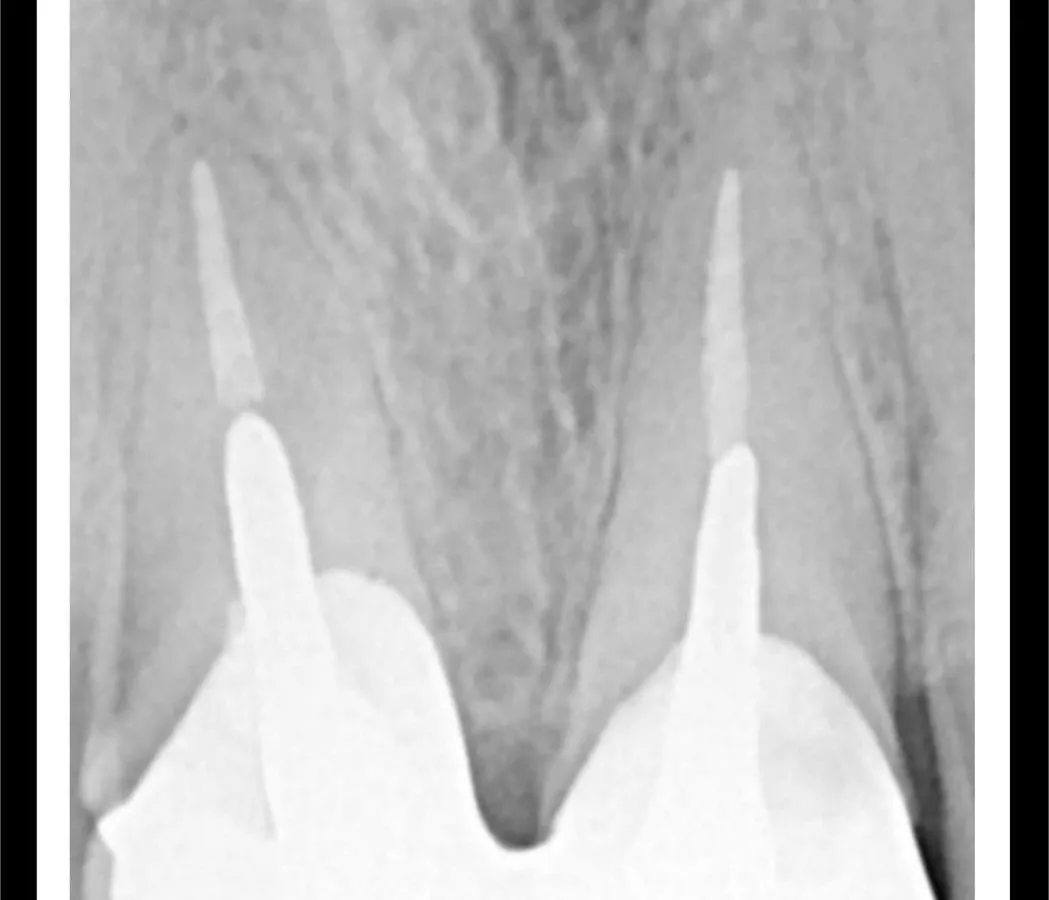 Radiografía digital de una endodoncia realizada en la consulta de Javier Ferreiro Odontólogo