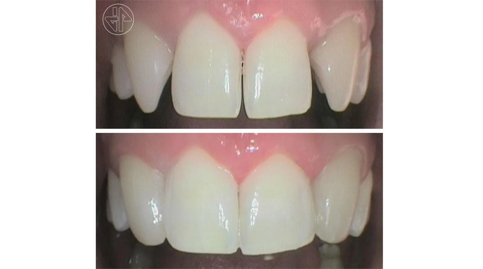 Caso real de Javier Ferreiro Odontólogo: incisivos antes y después de un tratamiento de estética dental