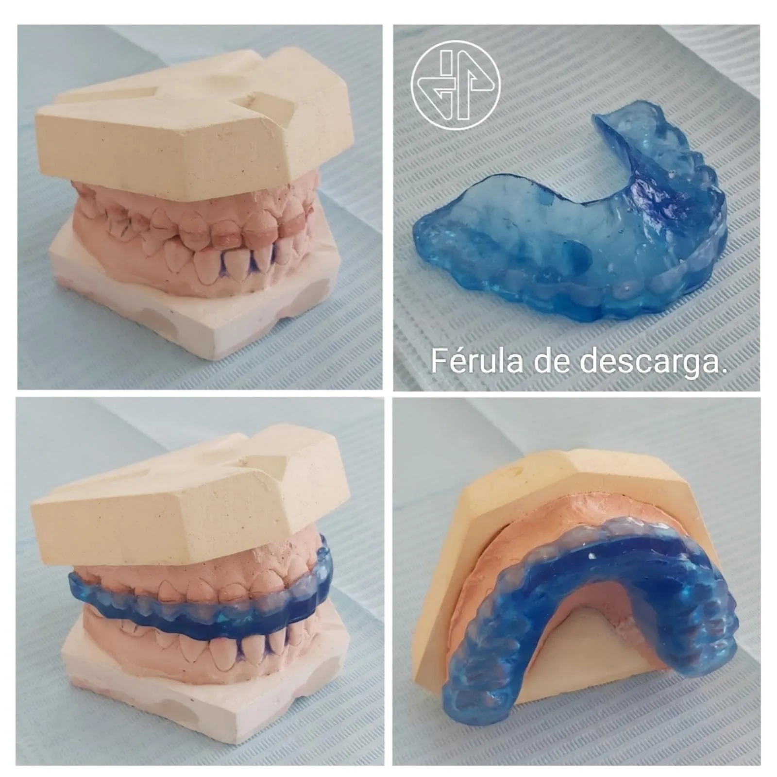 Férula de descarga azul y moldes de escayola de un paciente de Javier Ferreiro Odontólogo