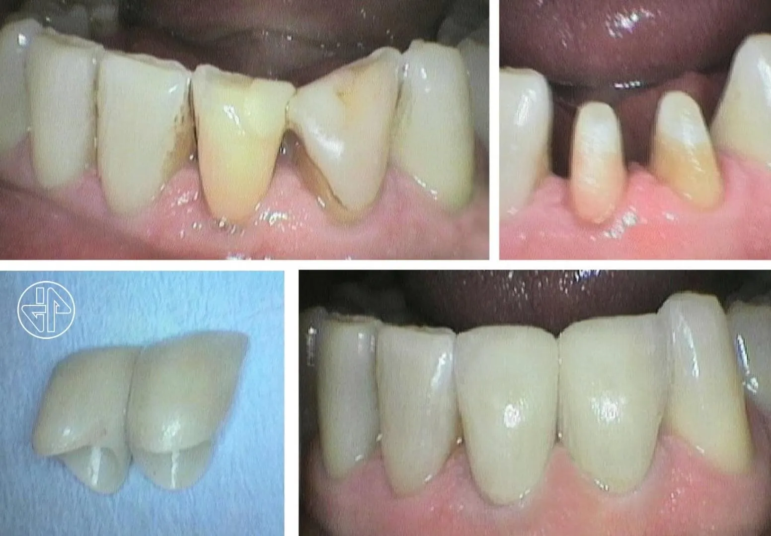 Caso real de Javier Ferreiro Odontólogo: dientes inferiores antes y después de colocar coronas de zirconio