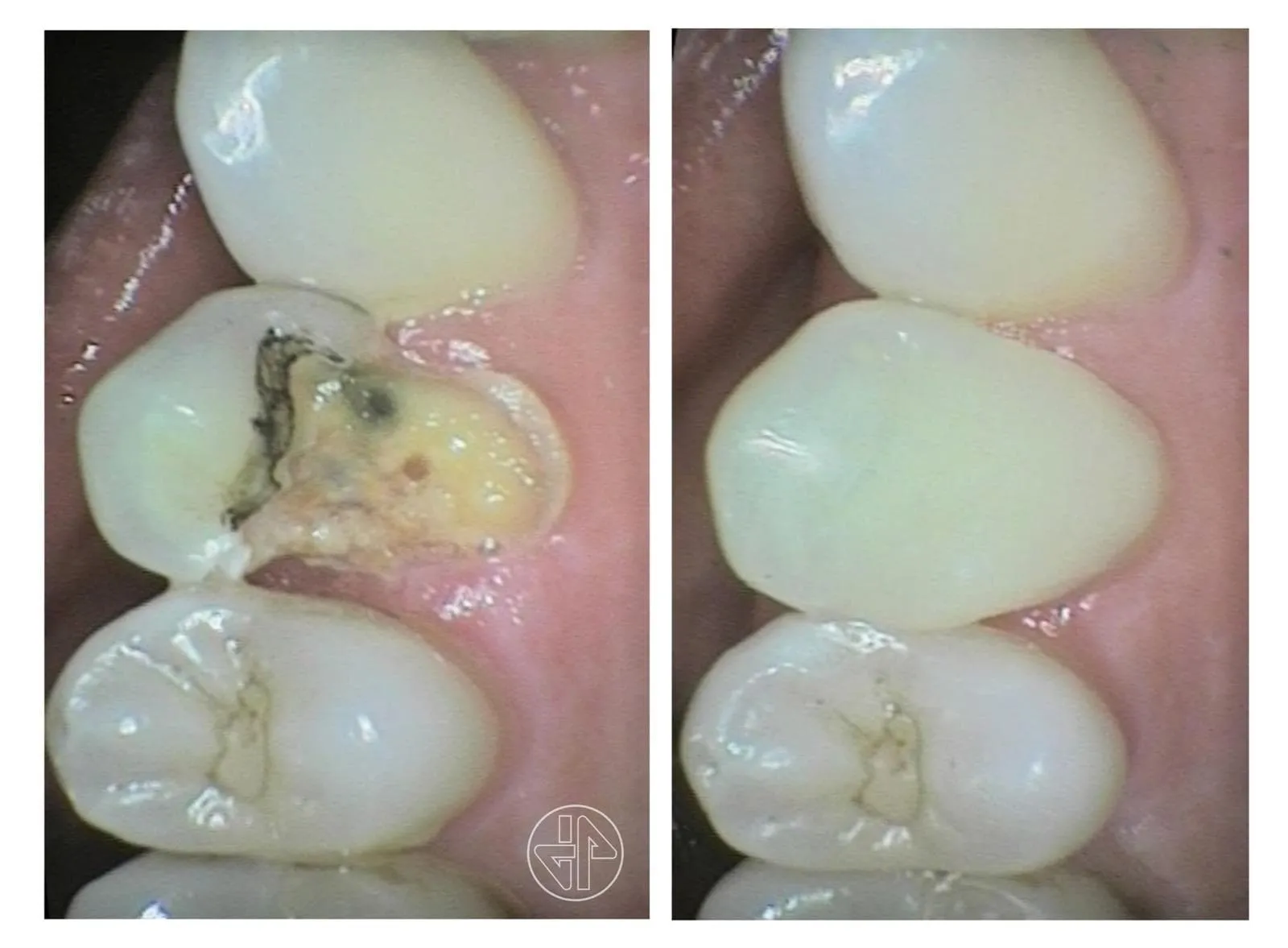 Caso real de Javier Ferreiro Odontólogo: muela con caries antes y después de restaurarla con composite
