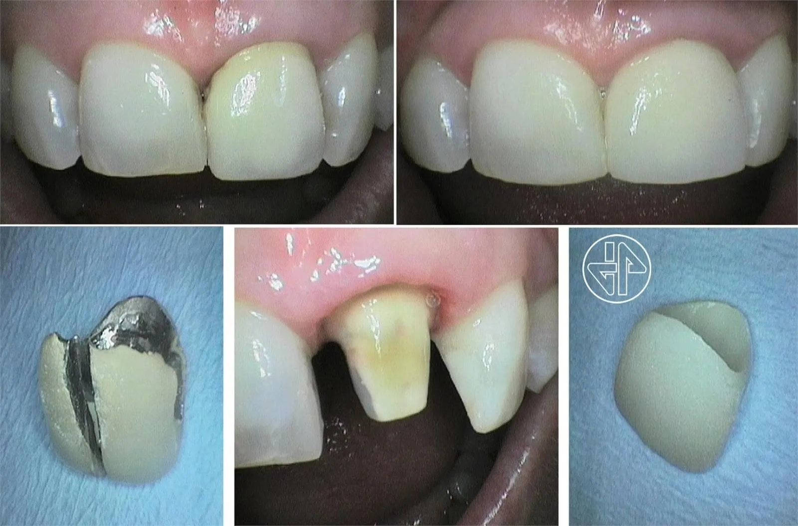 Registro fotográfico con cámara intraoral de una restauración realizada en Javier Ferreiro Odontólogo